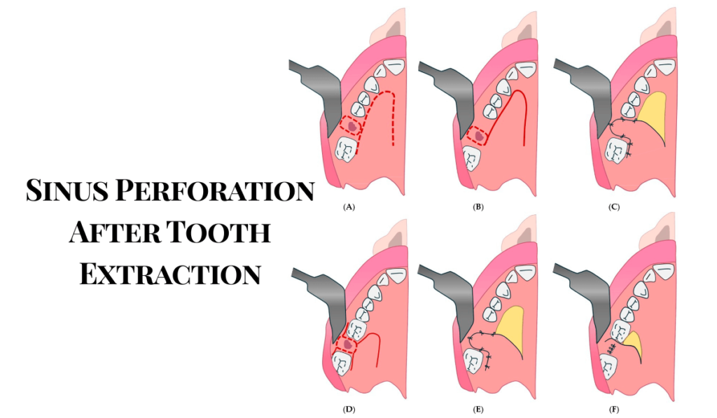Sinus Perforation After Tooth Extraction